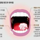 구내염에 대하여 이미지