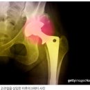 대퇴골 무혈성 괴사 '넓적다리 뼈머리가 썩는다' 이미지