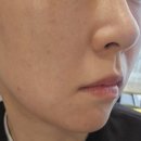 제이엠김정민피부과의원 | [판교 피부과/의원] 내돈내산 턱리프팅, 수액주사, 리쥬란힐러 후기