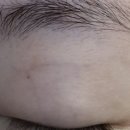 V-3 | 루미에의원 엑셀V레이저 체리 혈관종 빨간점 제거 3년 후기 최종