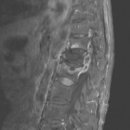 감염성 질환, 근골격질환, 뇌신경정신질환 결핵성 골수염 (Tuberculous osteomyelitis)이란? 이미지