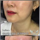 동성미용타운 | [수원 윤곽관리] 점심시간 30분의 기적! 아픈 자극 없이 탄탄하게 밀착되는 즉각 윤곽 레이저 후기**