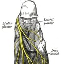 forefoot neuroma squeeze test -＞ Morton's neuroma 진단 이미지