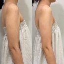 왕십리에스테틱 디유에스에스테틱 왕십리점 팔 슬리밍관리 후기