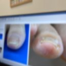 아무러스성형외과의원 | [대구/동대구역] 로에성형외과 내성발톱 치료 2탄｜임산부 동생도 치료받은 후기