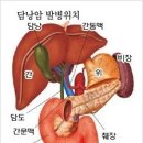 담낭수술 이후 갑작스런 췌장암, 담도암 이미지