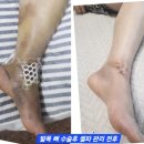 라라체형미관리센터 | 의학적으로 말도 안되는 기적같은 체험 사례, 발목 수술후 라라셀파를 통한 회복기