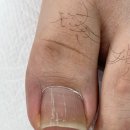 레푸스인하대역점 내성발톱 무좀발톱 발각질 문제성발 이미지