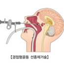 뇌하수체의 악성 신생물 (Malignant Neoplasm Of Pituitary Gland) 이미지