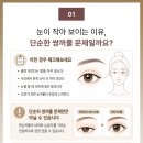 죽전안과의원 | 대구 안검하수 병원 찾기 전, 눈꺼풀 처짐과 진료 기준부터 확인하세요