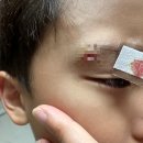 서울마더스성형외과 티스토리