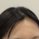 이소한의원 | 용산 여드름 피부과 유리알 밀크필 후기