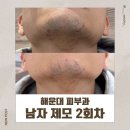 차플러스 | 해운대피부과 젠틀프로맥스플러스 남자제모후기 2회차 듬성듬성해진 턱수염