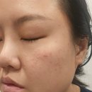 자연한의원 | 강남 편평사마귀 제거 자연재생한의원 얼굴 편평사마귀 제거 리얼후기