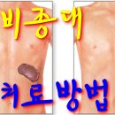 사암침, 사암침법 - 비종대 치료 방법 - 비과학적 양의학 123 이미지