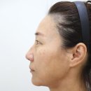 타임성형외과의원 | 40대 환자의 이마거상술, 눈밑거상술 실제 환자 1달 경과