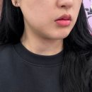 수원그리고의원 | 수원 티타늄리프팅 받고 온 수원 세모아의원 리프팅 후기