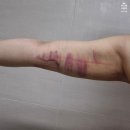 가메조네 | [인천] 팔 무한람스 1주일차 후기(+메조지분주사,극저온치료)