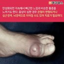 충영(개 다래 열매) 효능 이미지