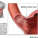 말로리바이스 증후군 원인 및 (오심, 구토, 피토, 토혈, 위출혈) 이미지