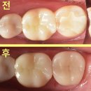 가야치과병원 | 방배동치과 치아 크랙 시 크라운 하지 말고 오버레이로 수명 연장하세요