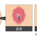 치열 카카오 검색결과