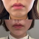 바노바기의원 | 바노바기의원 창원에서 턱끝필러 받은 솔직후기! (feat. 내돈내산)