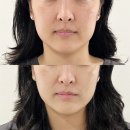 황제애견 | 수영피부관리 오비오에스테틱 하이푸 리프팅 후기