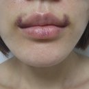 말분 | 인생 첫 필러! 레나필 1cc 부산 서면 성형외과 입술필러 10일 후기