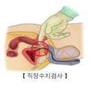 전립선암의 정확한 원인은 이미지