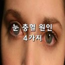 「건강」눈 충혈 원인 4가지 이미지