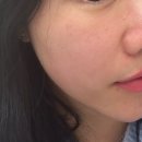 흑석역 피부과 포토나토닝 포토제닉 1회차 후기