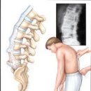 요추골절,요추골절증상,요추골절원인,요추골절치료,요추골절장해,요추골절장해진단,교통사고요추골절,요추골절합의,요추골절합의금,요추골절보상 이미지