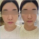 대공원역 2번 출구 앞 | 수성구리프팅 티나는한의원 EM피어리 관리로 중안부 리프팅 솔직후기