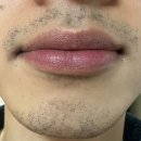 스노우의원 안산점 | 안산 중앙동 남자 수염 레이저 제모 내돈내산 1회차 후기 (feat. 가격)