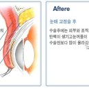 [눈성형,눈매교정,눈성형수술,쌍커풀,고운세상성형외과] 눈성형_눈매교정이란? 이미지