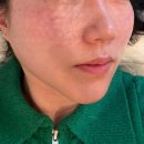 논현2-119 | 신논현역 피부과 우유빛의원 스킨부스터 후기 - 리쥬란 2cc 쥬베룩스킨2cc 맞춤 시술