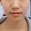 신사역피부과, 리프팅레이저 슈링크300샷 효과 통증 후기! 오랜만에 초음파리프팅(HIFU)♥