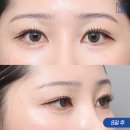 미드라인성형외과의원 | 미드라인, 눈 지방이식/필러 종류에 대해 알아보자!