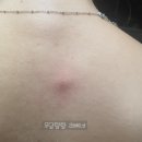 용인항유외과의원 | 용인항유외과 표피낭종 피지낭종 당일 제거 후기 및 172만원 보험금 수령