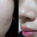 에이스킨(a skin)