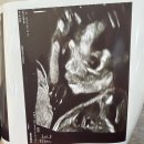 전원말6길 22 | 18w~22w) 태동 그리고 삼성서울병원 전원