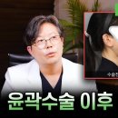 윤곽의정석성형외과의원 | 윤곽수술 후 생긴 턱 라인 불균형, 해결 방법은? | 강남역 다움성형외과에서 알려드립니다!