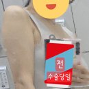 팔뚝 지흡 &amp; 얼굴 지방이식 이미지
