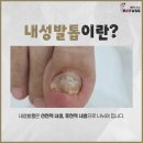 향남약국 | 향남 내성발톱, 고통 끝내는 확실한 방법은?