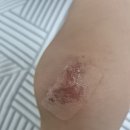 무릎 찰과상 상처 잘 아시는분.. ? 이미지