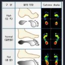 요족 증상, 합병증, 진단방법 이미지