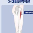 고관절 통증 원인과 대처법 이미지