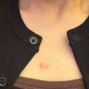 안성열성형외과피부과의원 | 피지낭종 가슴 켈로이드 제거 3탄 ; 명의를 찾아봅시다(연세스타, 안성열 등 견적 가격)