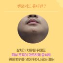 오해 | 턱 켈로이드 흉터 제거 수술 후기 | 피부병으로 오해하지 마세요